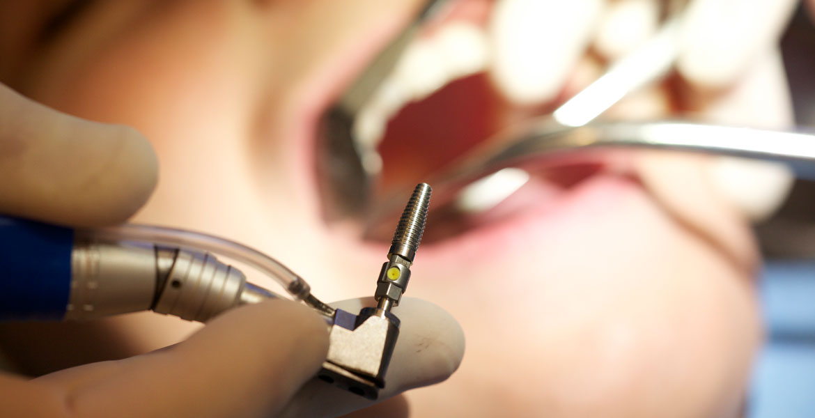 Prothese en Implantaten